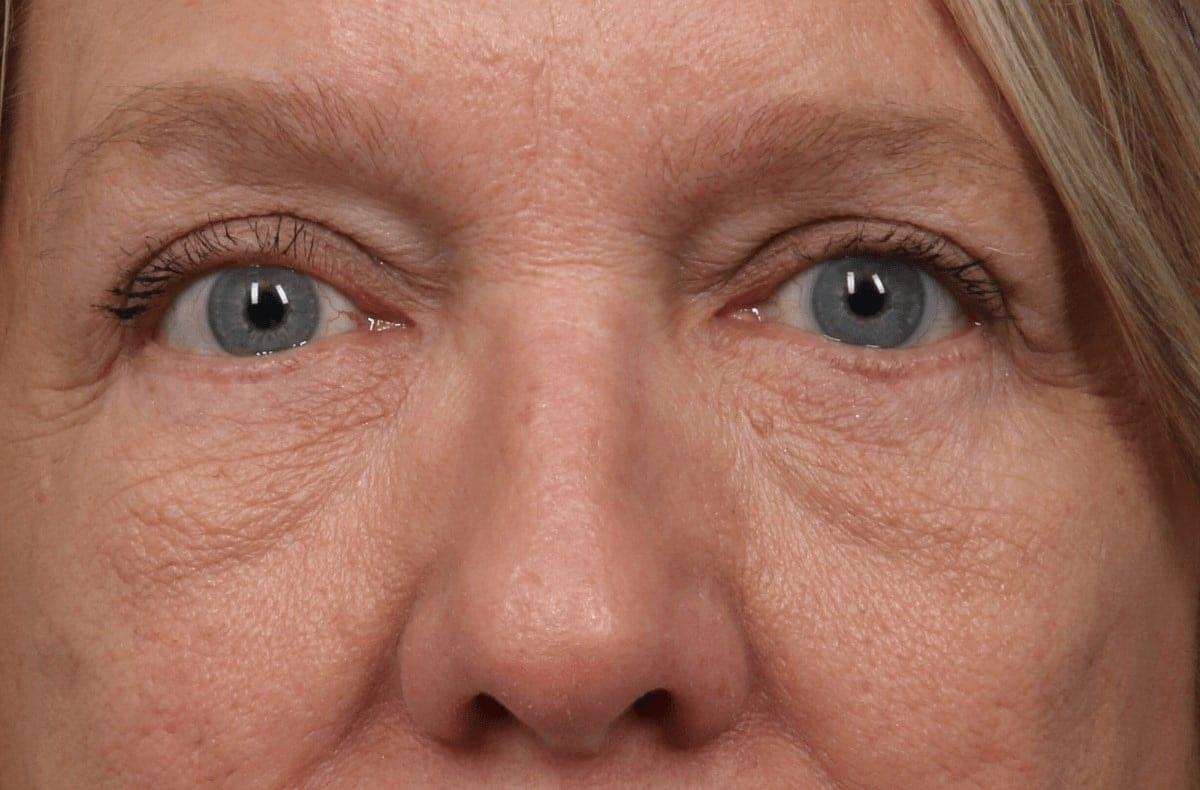 Alan B. Brackup, MD eyelid lift after — Langhorne, PA