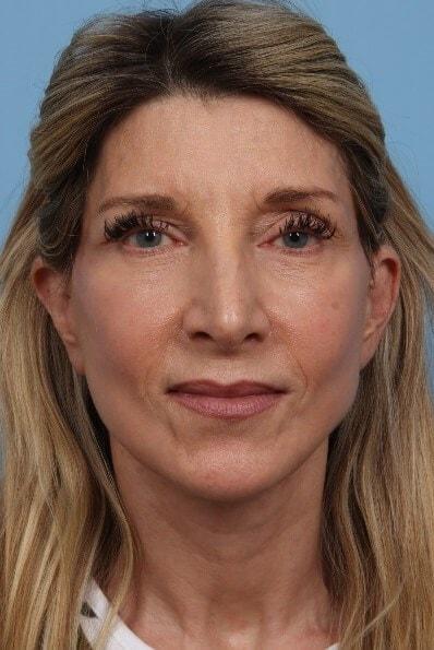 Alan B. Brackup, MD facelift after — Langhorne, PA