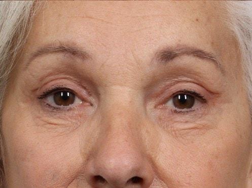 Alan B. Brackup, MD brow lift after — Langhorne, PA