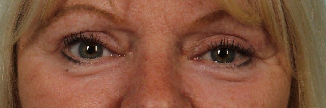 Alan B. Brackup, MD eyelid lift after — Langhorne, PA
