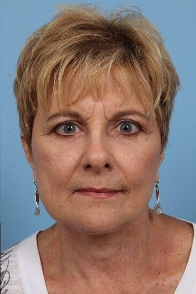 Alan B. Brackup, MD facelift after — Langhorne, PA
