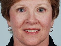 Alan B. Brackup, MD facelift after — Langhorne, PA