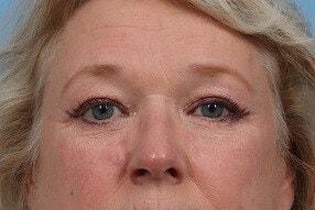 Alan B. Brackup, MD brow lift after — Langhorne, PA