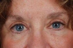 Alan B. Brackup, MD eyelid lift after — Langhorne, PA