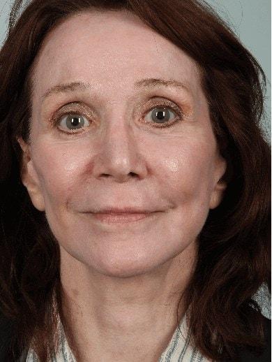Laser Skin Resurfacing after at Alan B. Brackup, MD in Langhorne, PA