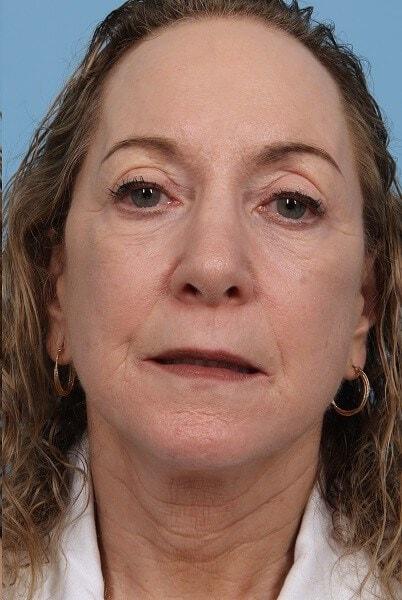 Alan B. Brackup, MD facelift after — Langhorne, PA