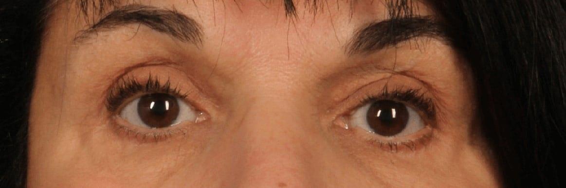 Alan B. Brackup, MD eyelid lift after — Langhorne, PA