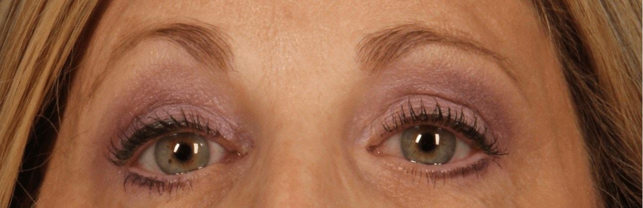 Alan B. Brackup, MD brow lift after — Langhorne, PA