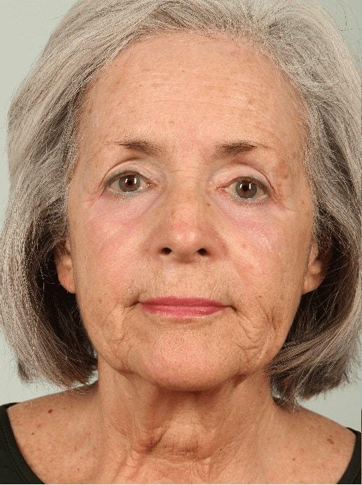 Laser Skin Resurfacing before at Alan B. Brackup, MD in Langhorne, PA