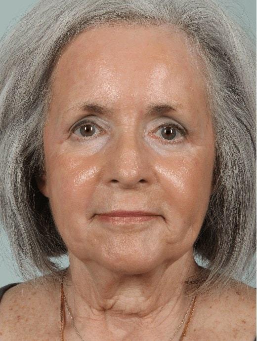 Laser Skin Resurfacing after at Alan B. Brackup, MD in Langhorne, PA