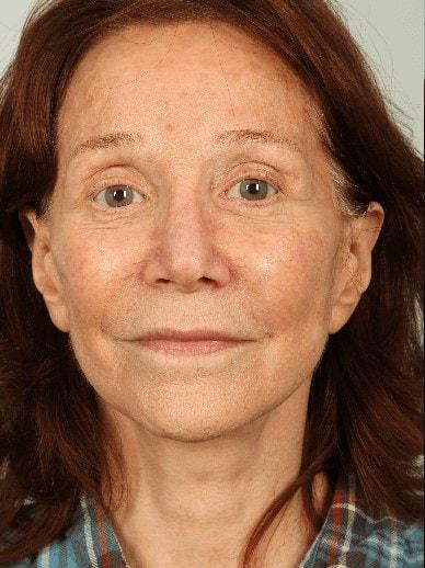 Laser Skin Resurfacing before at Alan B. Brackup, MD in Langhorne, PA