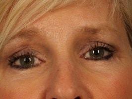 Alan B. Brackup, MD brow lift after — Langhorne, PA