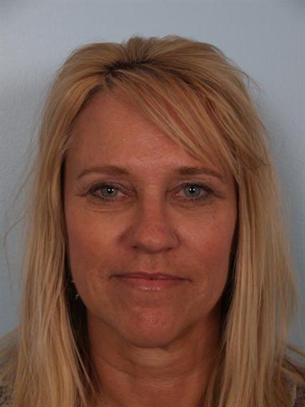 Brow Lift after at Dr. Robert Cohen Plastic Surgery in Beverly Hills, CA