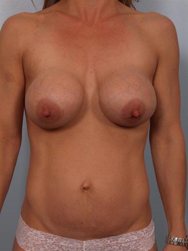 Tummy Tuck before at Dr. Robert Cohen Plastic Surgery in Beverly Hills, CA