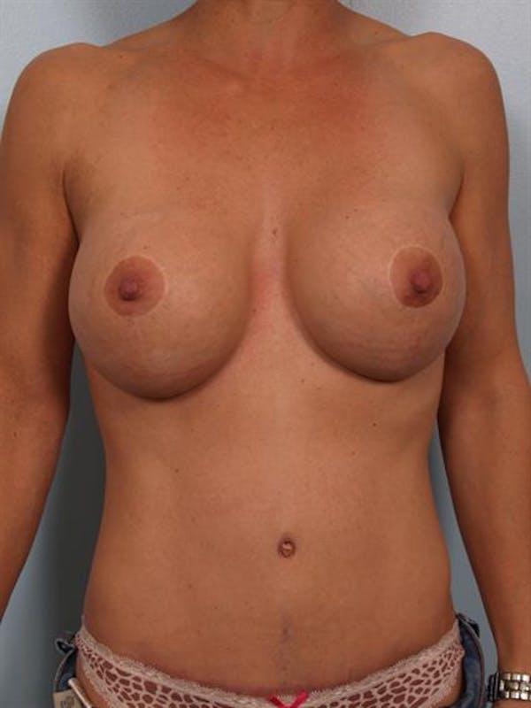 Tummy Tuck after at Dr. Robert Cohen Plastic Surgery in Beverly Hills, CA
