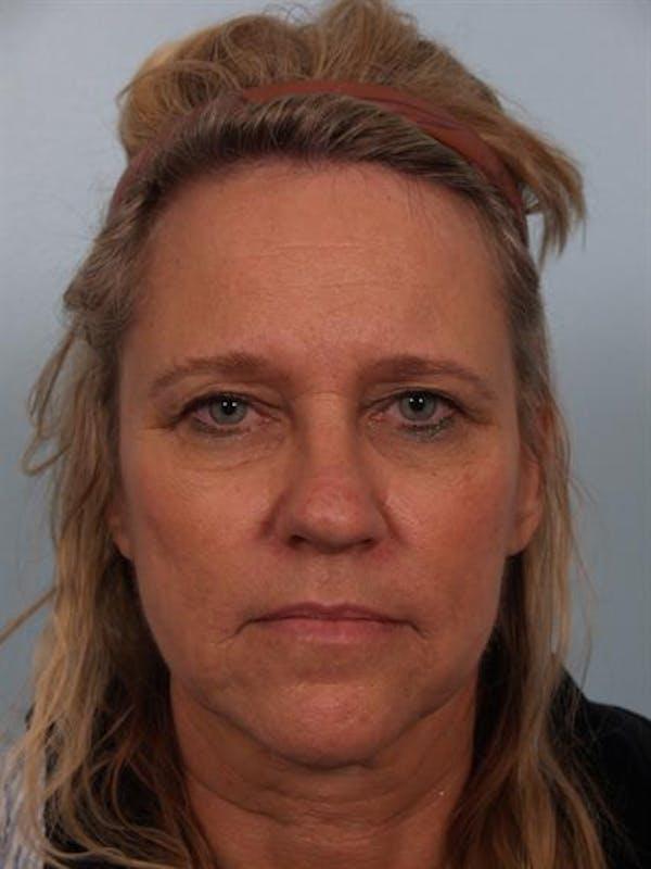 Blepharoplasty before at Dr. Robert Cohen Plastic Surgery in Beverly Hills, CA