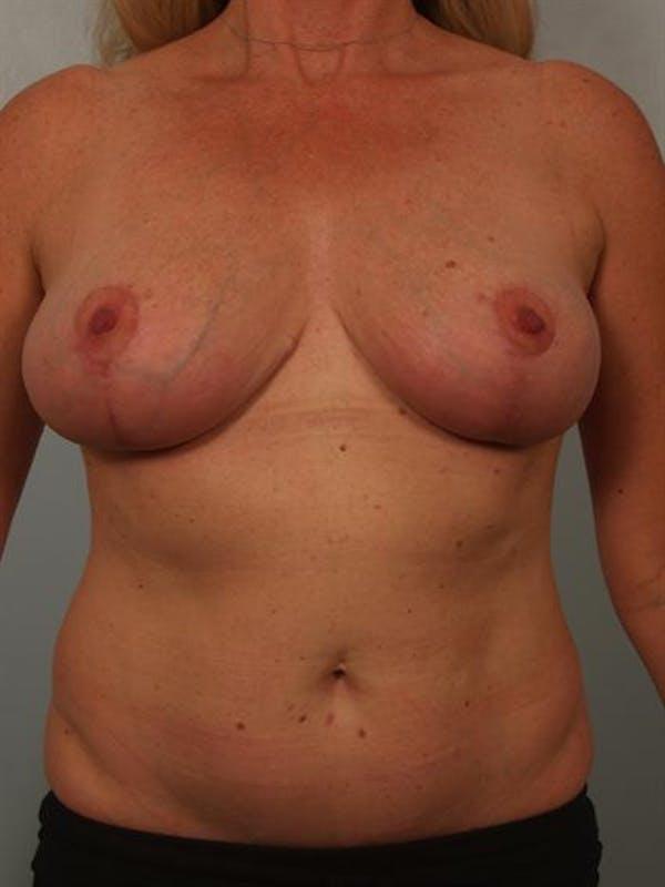 Breast Reduction after at Dr. Robert Cohen Plastic Surgery in Beverly Hills, CA