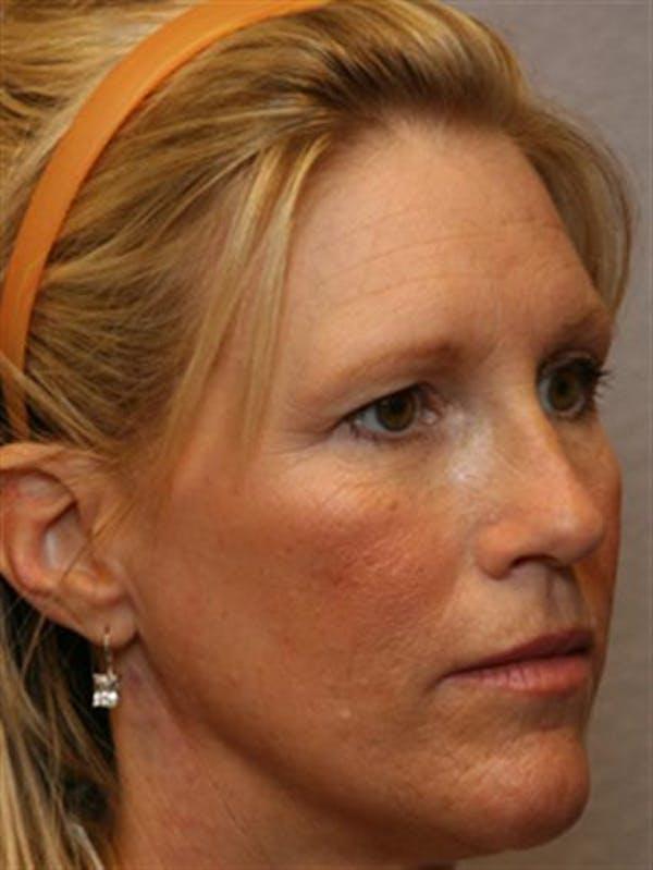 Brow Lift before at Dr. Robert Cohen Plastic Surgery in Beverly Hills, CA