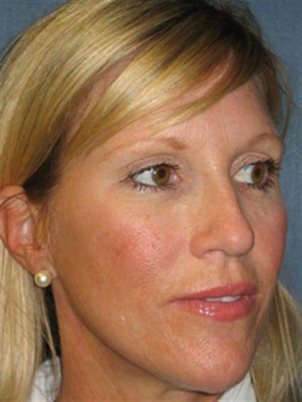 Brow Lift after at Dr. Robert Cohen Plastic Surgery in Beverly Hills, CA