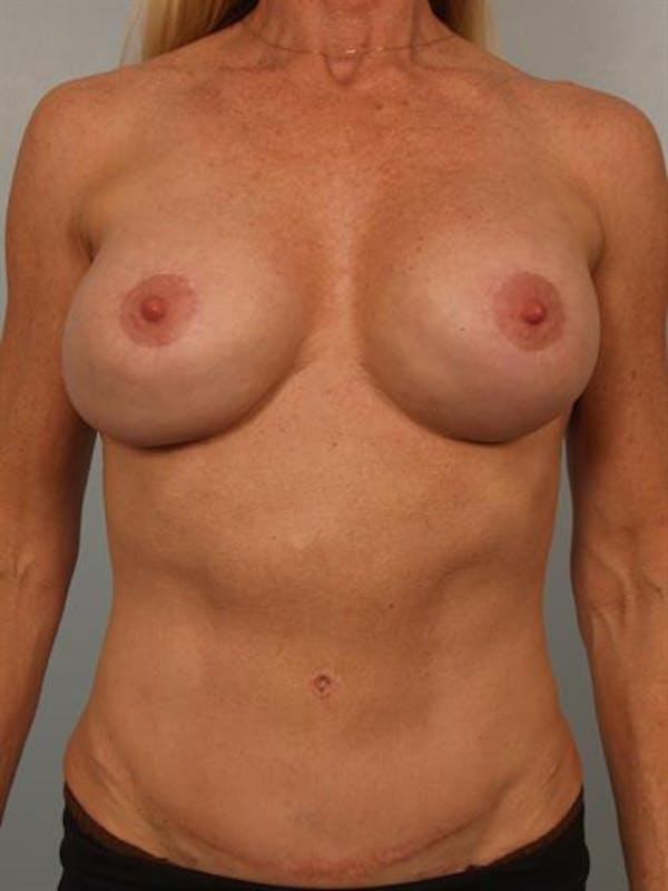 Fat Transfer before at Dr. Robert Cohen Plastic Surgery in Beverly Hills, CA