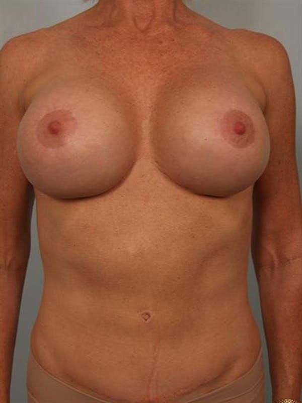 Fat Transfer after at Dr. Robert Cohen Plastic Surgery in Beverly Hills, CA