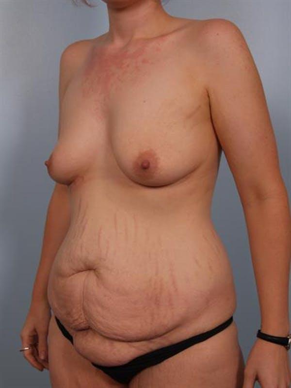 Mini Tummy Tuck before at Dr. Robert Cohen Plastic Surgery in Beverly Hills, CA