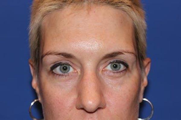 Blepharoplasty before at Dr. Robert Cohen Plastic Surgery in Beverly Hills, CA