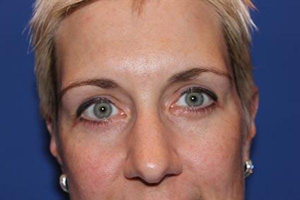 Dr. Robert Cohen Plastic Surgery blepharoplasty after — Beverly Hills, CA