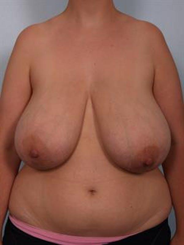 Breast Reduction after at Dr. Robert Cohen Plastic Surgery in Beverly Hills, CA