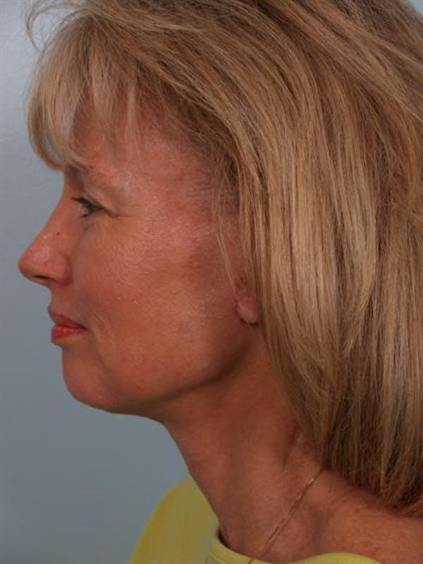 Facelift after at Dr. Robert Cohen Plastic Surgery in Beverly Hills, CA