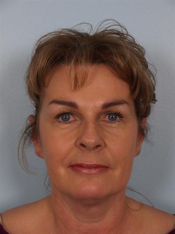 Brow Lift after at Dr. Robert Cohen Plastic Surgery in Beverly Hills, CA