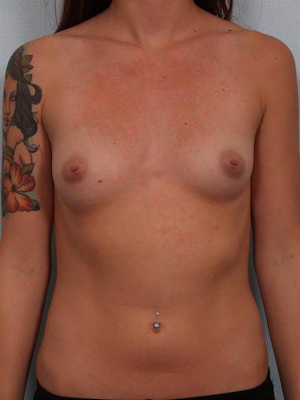 Fat Transfer before at Dr. Robert Cohen Plastic Surgery in Beverly Hills, CA