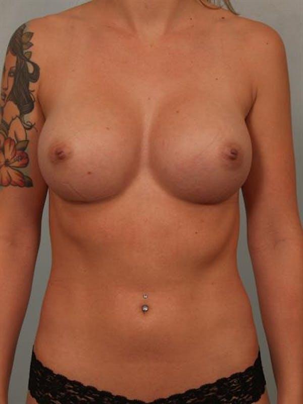 Fat Transfer after at Dr. Robert Cohen Plastic Surgery in Beverly Hills, CA