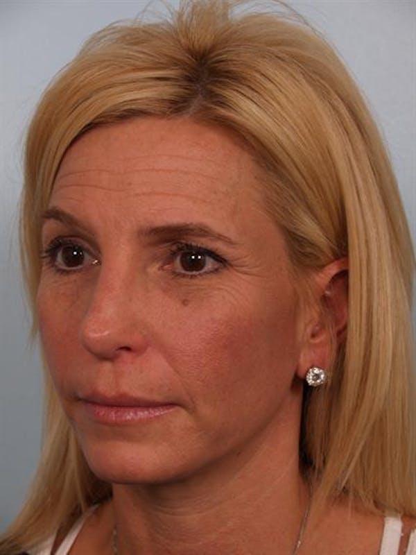 Brow Lift before at Dr. Robert Cohen Plastic Surgery in Beverly Hills, CA