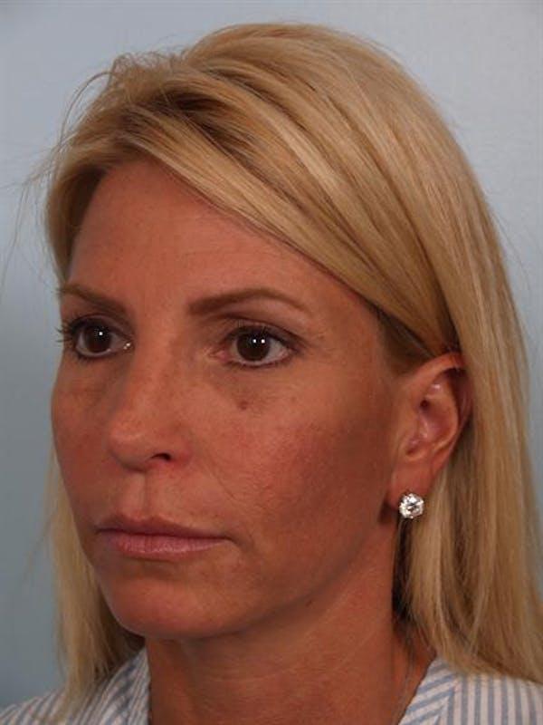 Brow Lift after at Dr. Robert Cohen Plastic Surgery in Beverly Hills, CA
