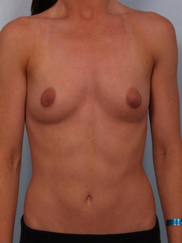 Breast Augmentation before at Dr. Robert Cohen Plastic Surgery in Beverly Hills, CA