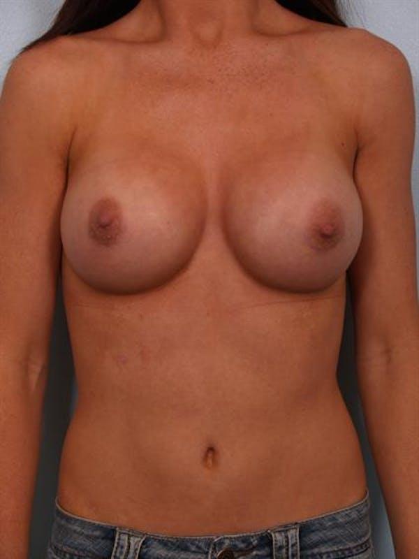 Breast Augmentation after at Dr. Robert Cohen Plastic Surgery in Beverly Hills, CA
