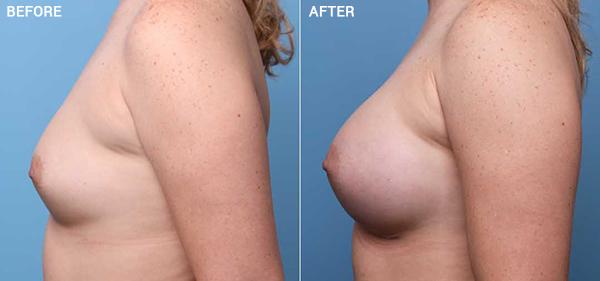 Breast Augmentation result at Nebraska Medicine Village Pointe Aesthetic Surgery | Dreams MedSpa in Omaha, NE