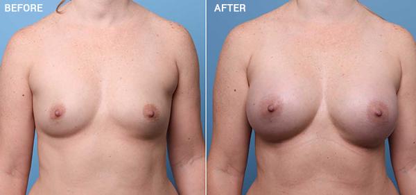 Breast Augmentation result at Nebraska Medicine Village Pointe Aesthetic Surgery | Dreams MedSpa in Omaha, NE