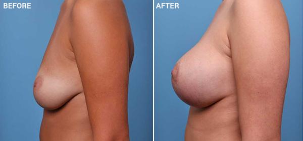 Breast Lift result at Nebraska Medicine Village Pointe Aesthetic Surgery | Dreams MedSpa in Omaha, NE