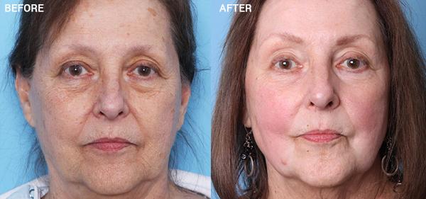 Chemical Peel result at Nebraska Medicine Village Pointe Aesthetic Surgery | Dreams MedSpa in Omaha, NE
