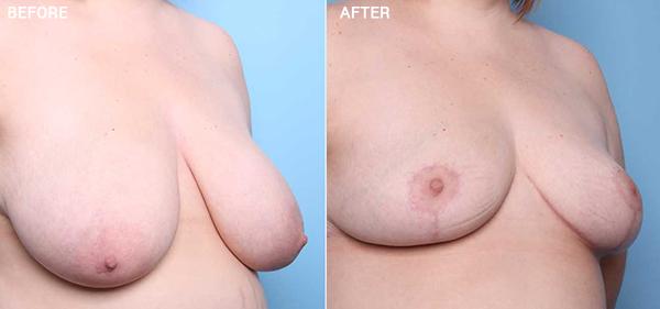 Breast Reduction result at Nebraska Medicine Village Pointe Aesthetic Surgery | Dreams MedSpa in Omaha, NE