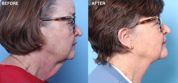 Facelift result at Nebraska Medicine Village Pointe Aesthetic Surgery | Dreams MedSpa in Omaha, NE