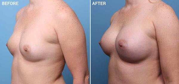 Breast Augmentation result at Nebraska Medicine Village Pointe Aesthetic Surgery | Dreams MedSpa in Omaha, NE