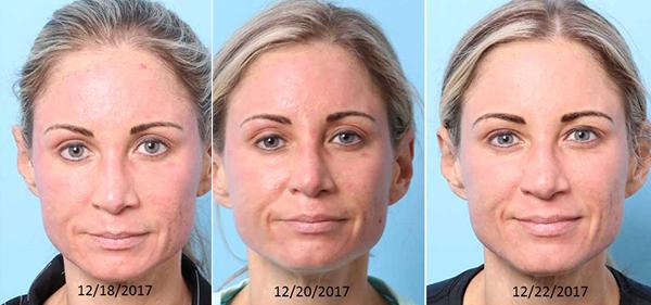 Chemical Peel result at Nebraska Medicine Village Pointe Aesthetic Surgery | Dreams MedSpa in Omaha, NE