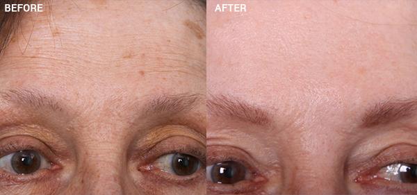 Chemical Peel result at Nebraska Medicine Village Pointe Aesthetic Surgery | Dreams MedSpa in Omaha, NE