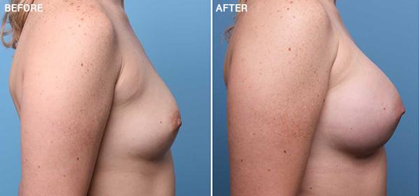Breast Augmentation result at Nebraska Medicine Village Pointe Aesthetic Surgery | Dreams MedSpa in Omaha, NE