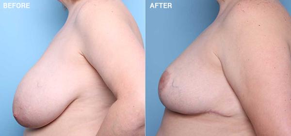 Breast Reduction result at Nebraska Medicine Village Pointe Aesthetic Surgery | Dreams MedSpa in Omaha, NE