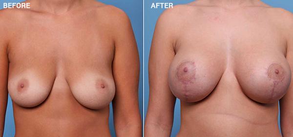 Breast Lift result at Nebraska Medicine Village Pointe Aesthetic Surgery | Dreams MedSpa in Omaha, NE