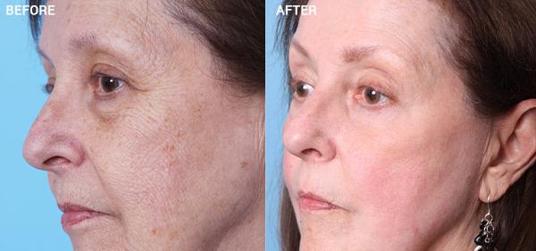 Chemical Peel result at Nebraska Medicine Village Pointe Aesthetic Surgery | Dreams MedSpa in Omaha, NE